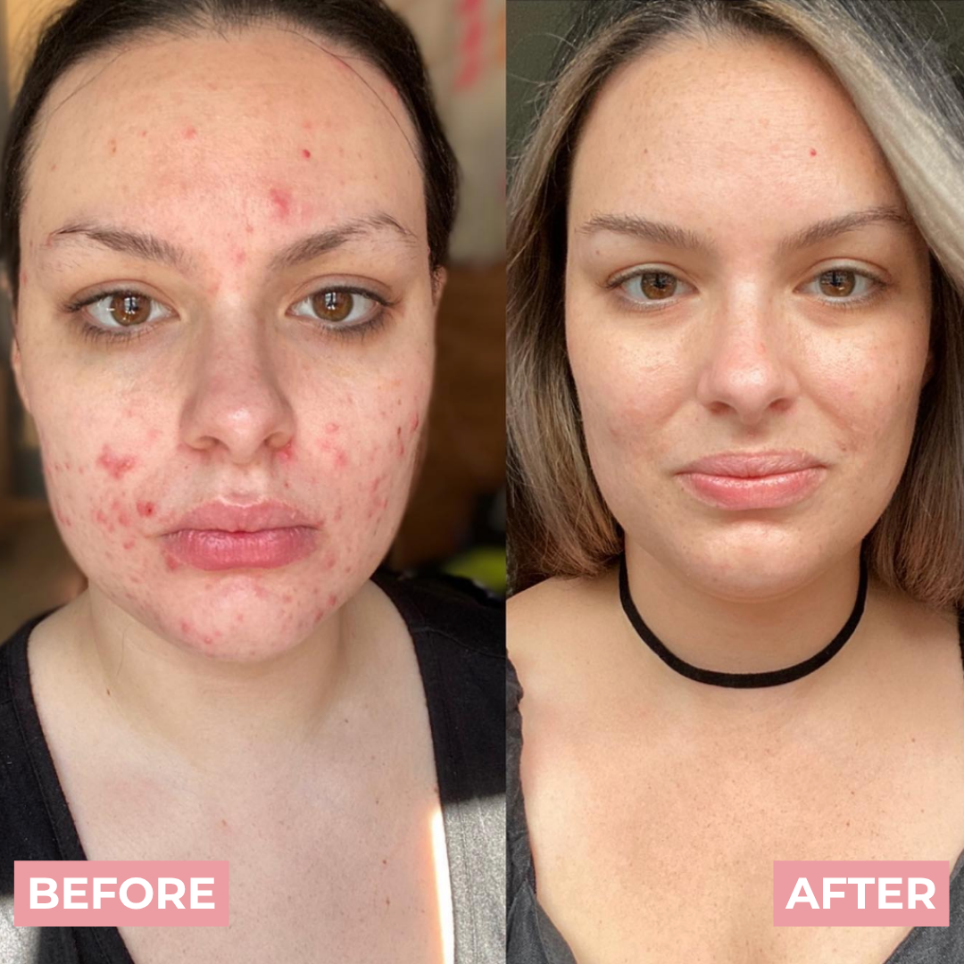 PDRN Pink Collagen Exosome Shot Acne Serum