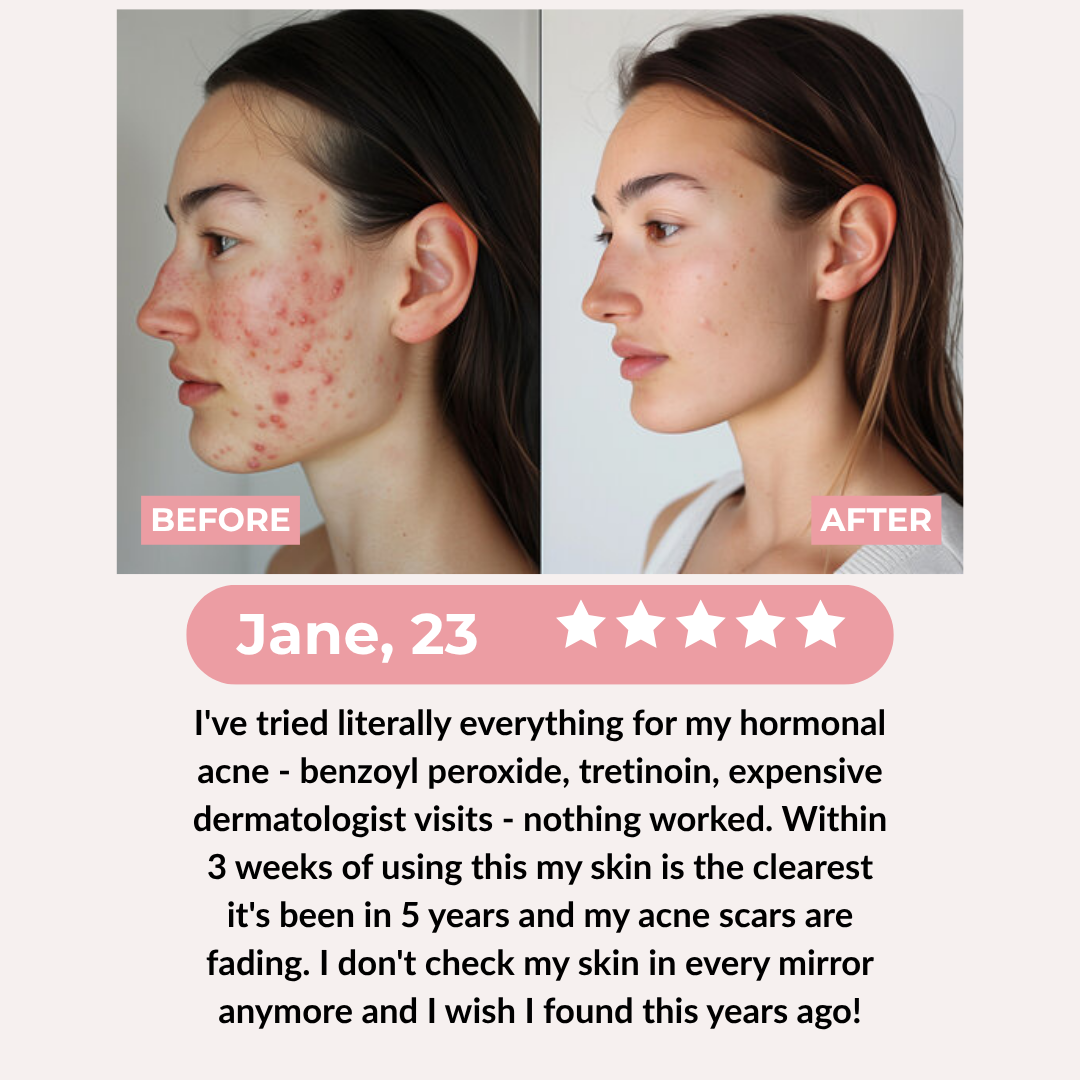 PDRN Pink Collagen Exosome Shot Acne Serum