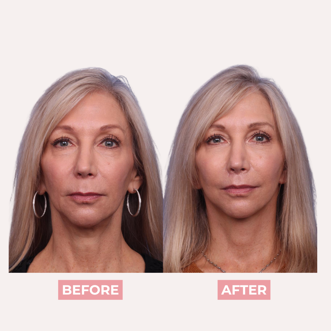 PDRN Pink Collagen Exosome Shot Anti-Aging Serum